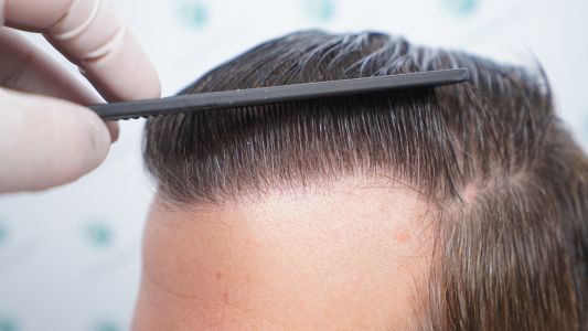 Injerto Capilar Técnica FUE Grafts 2365 (5983 Pelos) - REPARACIÓN 39 RESULTADOS INJERTO CAPILAR EN 12 MESES