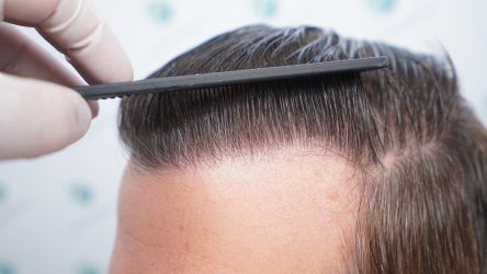 Injerto Capilar Técnica FUE Grafts 2365 (5983 Pelos) - REPARACIÓN 35 RESULTADOS INJERTO CAPILAR EN 12 MESES