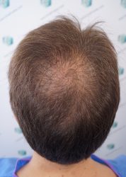 Injerto Capilar Técnica FUE Grafts 2365 (5983 Pelos) - REPARACIÓN 4 ANTES DE UN TRASPLANTE CAPILAR