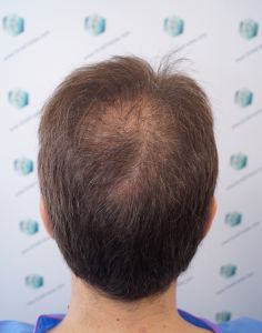 Injerto Capilar Técnica FUE Grafts 2365 (5983 Pelos) - REPARACIÓN 5 ANTES DE UN TRASPLANTE CAPILAR