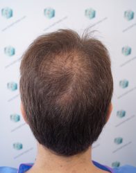 Injerto Capilar Técnica FUE Grafts 2365 (5983 Pelos) - REPARACIÓN 5 ANTES DE UN TRASPLANTE CAPILAR