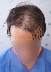 DISEÑO LÍNEA INJERTO CAPILAR DISEÑO LINEA INJERTO CAPILAR