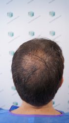 Injerto Capilar Técnica FUE Grafts 2365 (5983 Pelos) - REPARACIÓN 6 DISEÑO LINEA INJERTO CAPILAR