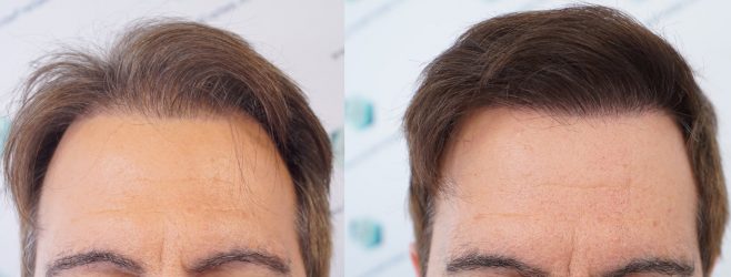 COMPARATIVA INJERTO CAPILAR ANTES Y DESPUÉS ANTES Y DESPUES DE UN TRASPLANTE CAPILAR
