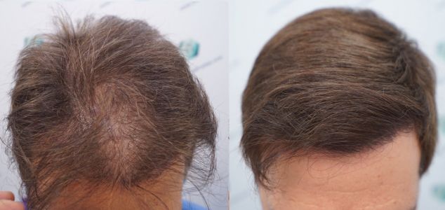Injerto Capilar Técnica FUE Grafts 2365 (5983 Pelos) - REPARACIÓN 41 ANTES Y DESPUES DE UN TRASPLANTE CAPILAR