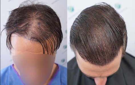 Injerto Capilar Técnica FUE Grafts 2365 (5983 Pelos) - REPARACIÓN 42 ANTES Y DESPUES DE UN TRASPLANTE CAPILAR
