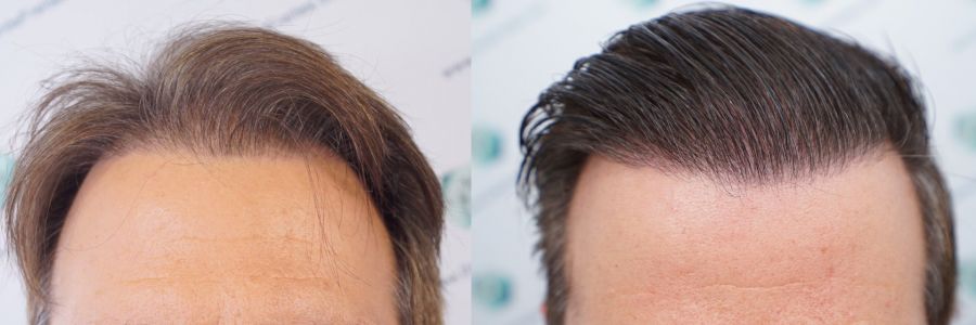 Injerto Capilar Técnica FUE Grafts 2365 (5983 Pelos) - REPARACIÓN 43 ANTES Y DESPUES DE UN TRASPLANTE CAPILAR