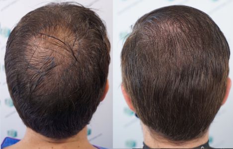 Injerto Capilar Técnica FUE Grafts 2365 (5983 Pelos) - REPARACIÓN 44 ANTES Y DESPUES DE UN TRASPLANTE CAPILAR