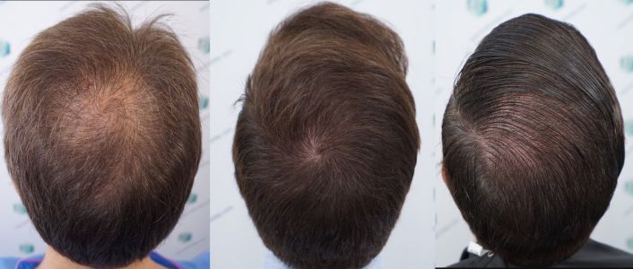 Injerto Capilar Técnica FUE Grafts 2365 (5983 Pelos) - REPARACIÓN 45 ANTES Y DESPUES DE UN TRASPLANTE CAPILAR