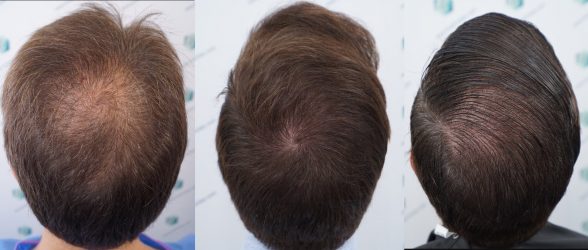 Injerto Capilar Técnica FUE Grafts 2365 (5983 Pelos) - REPARACIÓN 41 ANTES Y DESPUES DE UN TRASPLANTE CAPILAR