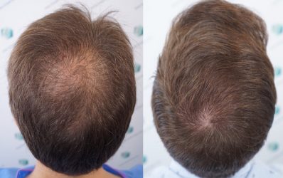 Injerto Capilar Técnica FUE Grafts 2365 (5983 Pelos) - REPARACIÓN 42 ANTES Y DESPUES DE UN TRASPLANTE CAPILAR