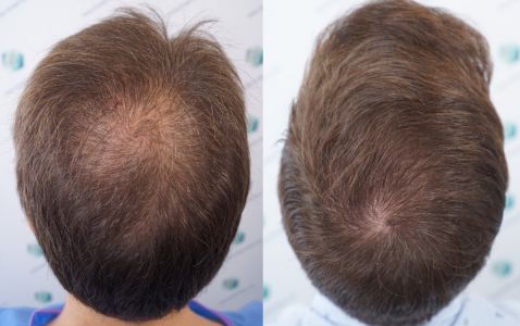 Injerto Capilar Técnica FUE Grafts 2365 (5983 Pelos) - REPARACIÓN 46 ANTES Y DESPUES DE UN TRASPLANTE CAPILAR