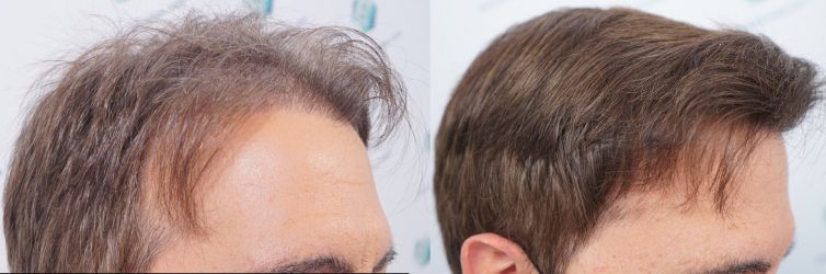 Injerto Capilar Técnica FUE Grafts 2365 (5983 Pelos) - REPARACIÓN 43 ANTES Y DESPUES DE UN TRASPLANTE CAPILAR