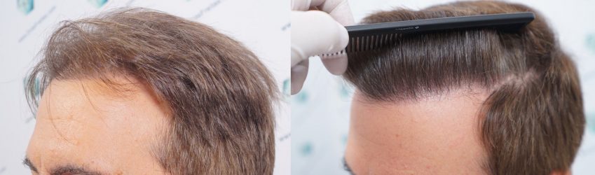 Injerto Capilar Técnica FUE Grafts 2365 (5983 Pelos) - REPARACIÓN 44 ANTES Y DESPUES DE UN TRASPLANTE CAPILAR