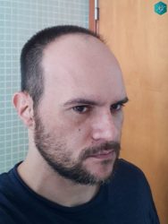 ANTES DEL TRASPLANTE CAPILAR ANTES DEL TRASPLANTE CAPILAR