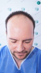 Injerto Capilar Técnica FUE Grafts 3223 (9295 Pelos) 1 ANTES DEL TRASPLANTE CAPILAR