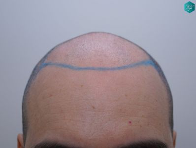 Injerto Capilar Técnica FUE 6557 Grafts (14215 Pelos) 8 10 DISEÑO 1
