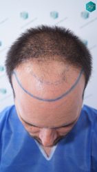 Injerto Capilar Técnica FUE Grafts 3223 (9295 Pelos) 9 DISEÑO LINEA INJERTO CAPILAR