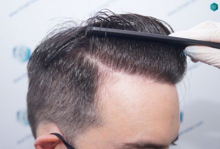 Injerto Capilar Técnica FUE 6557 Grafts (14215 Pelos) 78 100 EN 12 MESES