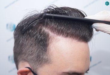 Injerto Capilar Técnica FUE 6557 Grafts (14215 Pelos) 76 100 EN 12 MESES