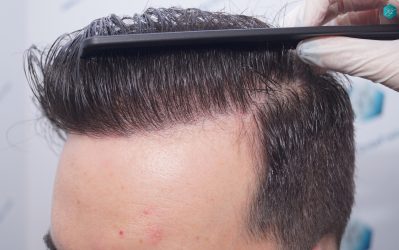 Injerto Capilar Técnica FUE 6557 Grafts (14215 Pelos) 77 101 EN 12 MESES