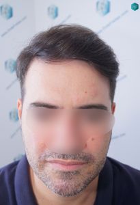 Injerto Capilar Técnica FUE 6557 Grafts (14215 Pelos) 80 102 EN 12 MESES