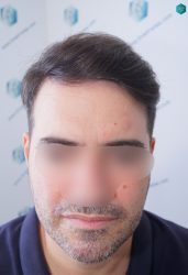 Injerto Capilar Técnica FUE 6557 Grafts (14215 Pelos) 78 102 EN 12 MESES