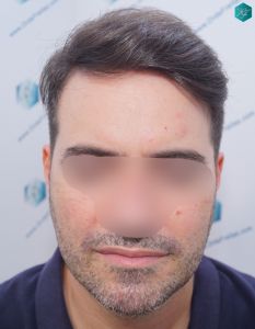 Injerto Capilar Técnica FUE 6557 Grafts (14215 Pelos) 81 103 EN 12 MESES