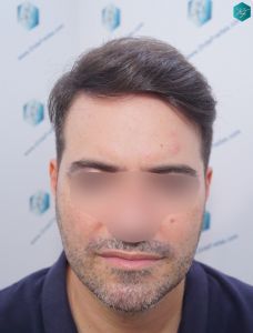 Injerto Capilar Técnica FUE 6557 Grafts (14215 Pelos) 82 104 EN 12 MESES
