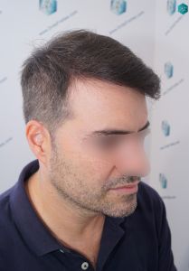 Injerto Capilar Técnica FUE 6557 Grafts (14215 Pelos) 83 107 EN 12 MESES