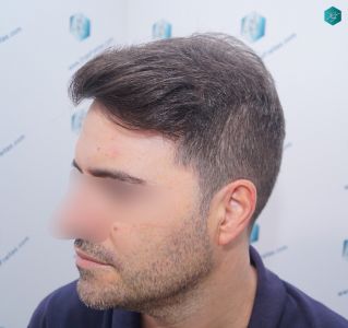 Injerto Capilar Técnica FUE 6557 Grafts (14215 Pelos) 84 109 EN 12 MESES