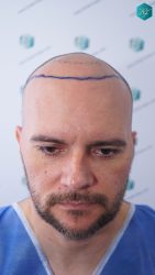 Injerto Capilar Técnica FUE Grafts 3223 (9295 Pelos) 10 DISEÑO LINEA INJERTO CAPILAR