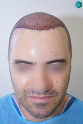 TRASPLANTE INJERTO CAPILAR TRASPLANTE INJERTO CAPILAR