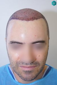TRASPLANTE INJERTO CAPILAR TRASPLANTE INJERTO CAPILAR