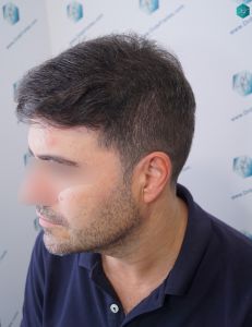 Injerto Capilar Técnica FUE 6557 Grafts (14215 Pelos) 85 110 EN 12 MESES