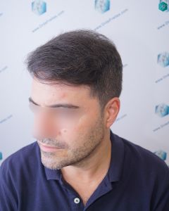 Injerto Capilar Técnica FUE 6557 Grafts (14215 Pelos) 86 111 EN 12 MESES