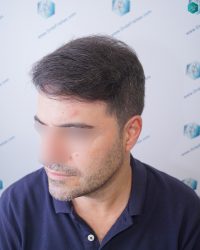 Injerto Capilar Técnica FUE 6557 Grafts (14215 Pelos) 84 111 EN 12 MESES