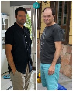 Injerto Capilar Técnica FUE 6557 Grafts (14215 Pelos) 87 114 COMPARATIVA