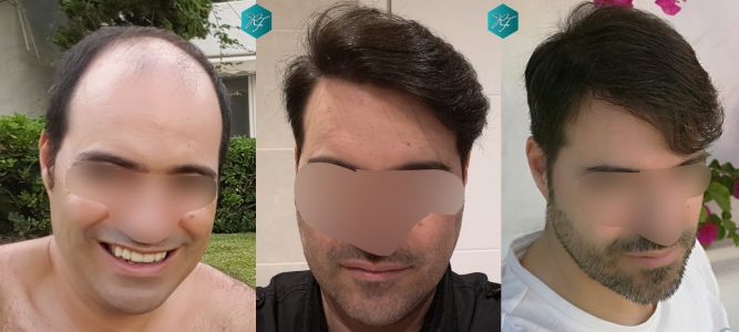 Injerto Capilar Técnica FUE 6557 Grafts (14215 Pelos) 88 115 COMPARATIVA