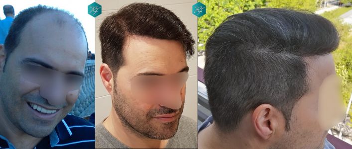 Injerto Capilar Técnica FUE 6557 Grafts (14215 Pelos) 89 116 COMPARATIVA