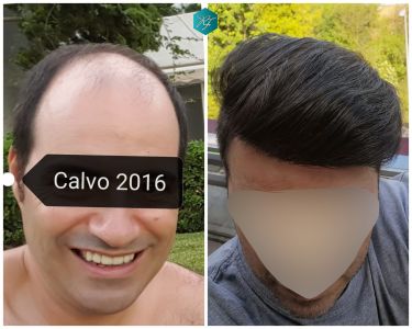 Injerto Capilar Técnica FUE 6557 Grafts (14215 Pelos) 90 117 COMPARATIVA