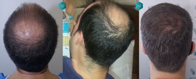 Injerto Capilar Técnica FUE 6557 Grafts (14215 Pelos) 91 118 COMPARATIVA