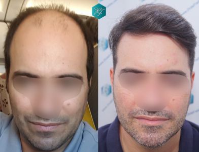 Injerto Capilar Técnica FUE 6557 Grafts (14215 Pelos) 92 119 COMPARATIVA