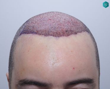 Injerto Capilar Técnica FUE 6557 Grafts (14215 Pelos) 9 12 TRASPLANTE