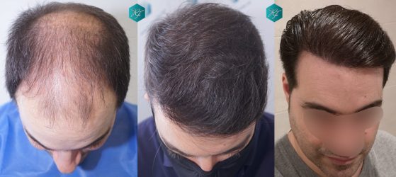 Injerto Capilar Técnica FUE 6557 Grafts (14215 Pelos) 91 COMPARATIVA ANTES Y DESPUÉS