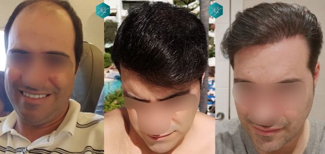 Injerto Capilar Técnica FUE 6557 Grafts (14215 Pelos) 94 121 COMPARATIVA