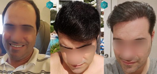 Injerto Capilar Técnica FUE 6557 Grafts (14215 Pelos) 92 121 COMPARATIVA