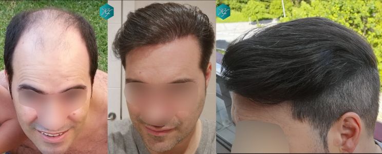 Injerto Capilar Técnica FUE 6557 Grafts (14215 Pelos) 95 122 COMPARATIVA