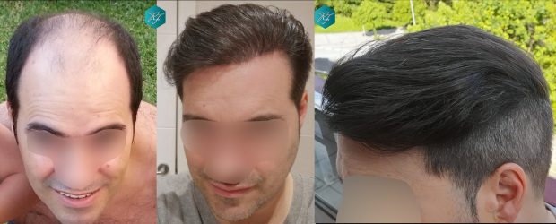 Injerto Capilar Técnica FUE 6557 Grafts (14215 Pelos) 93 122 COMPARATIVA
