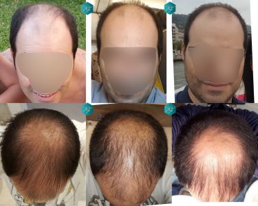 Injerto Capilar Técnica FUE 6557 Grafts (14215 Pelos) 96 123 COMPARATIVA